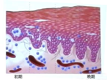 eczema-time.jpg