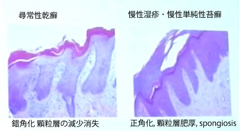 psori-eczema-copy.jpg