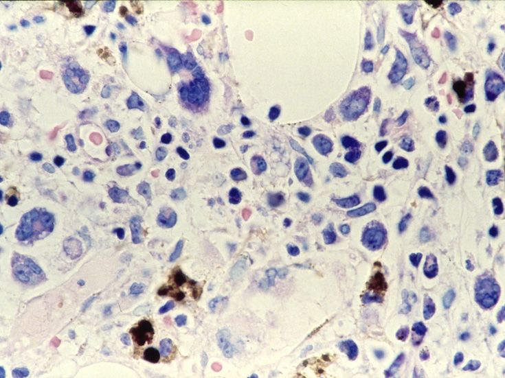 M7_biopsyMG.jpg