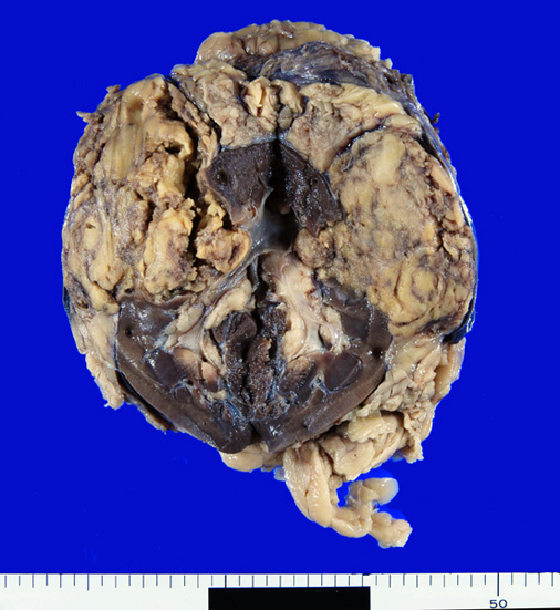 kidneyAML.jpg