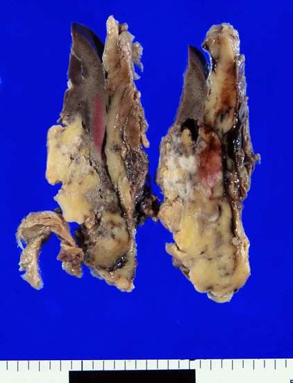 kidneyAMLcut.jpg