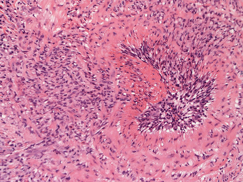 fibrinoidnecrosis01.jpg