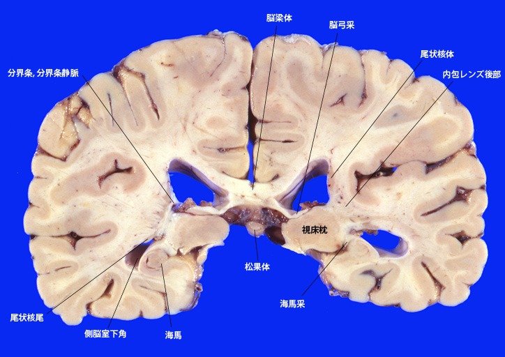 pineal_body.jpg