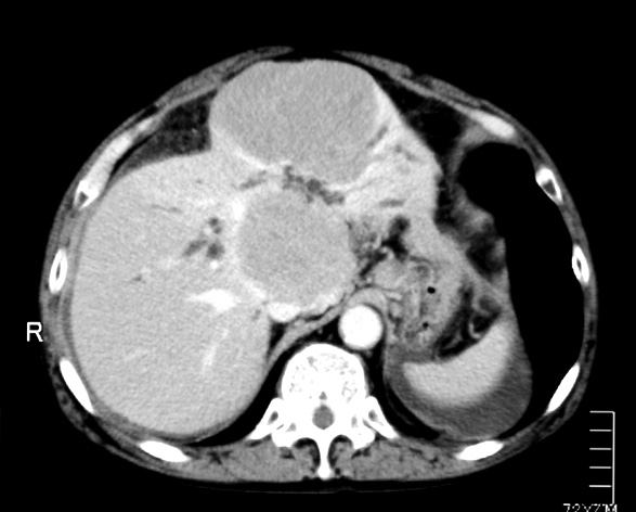 livertumor.jpg