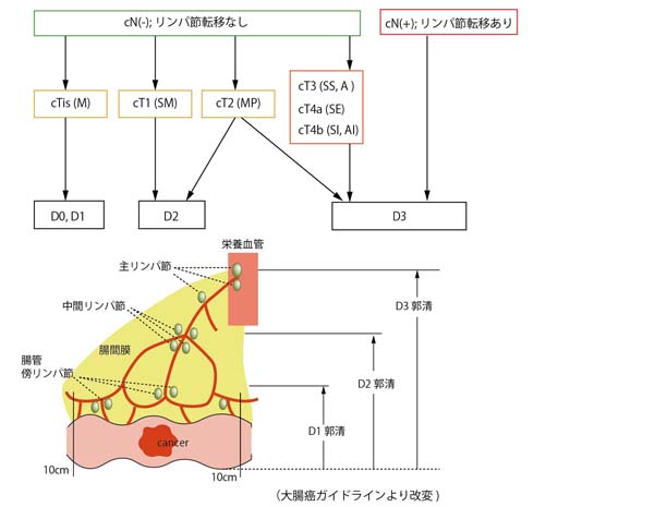 colorectalCa-operation.jpg