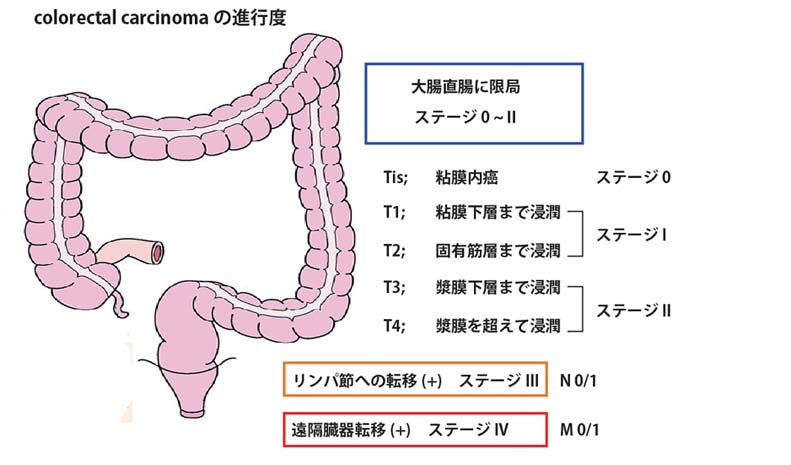 colorectalCa-stage.jpg