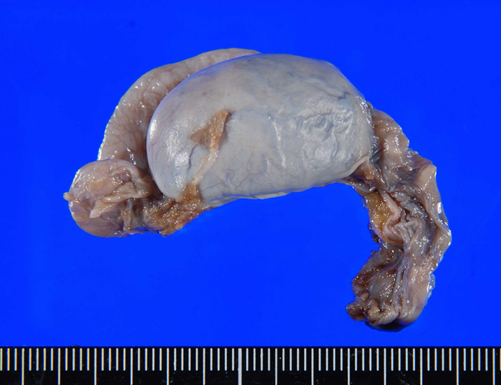 cryptorchidism01.jpg