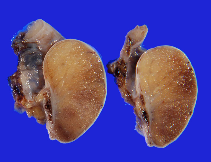 cryptorchidism02.jpg