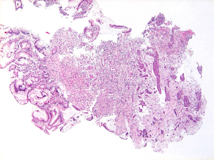 biopsyloupe01.jpg