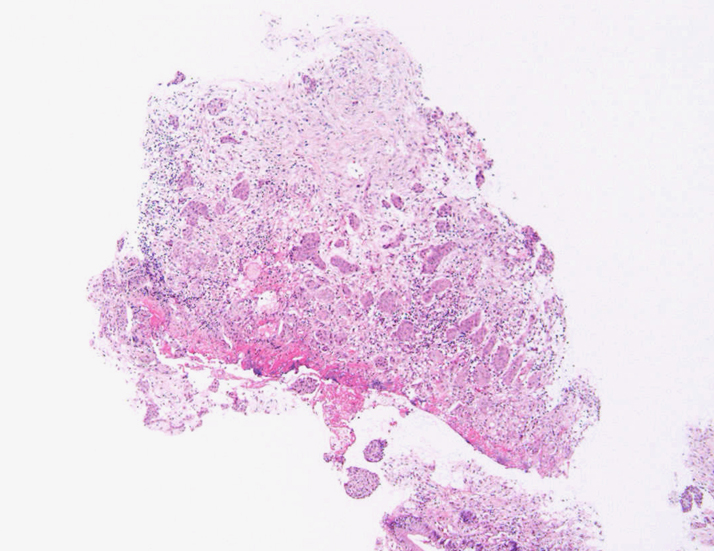 biopsyloupe02.jpg