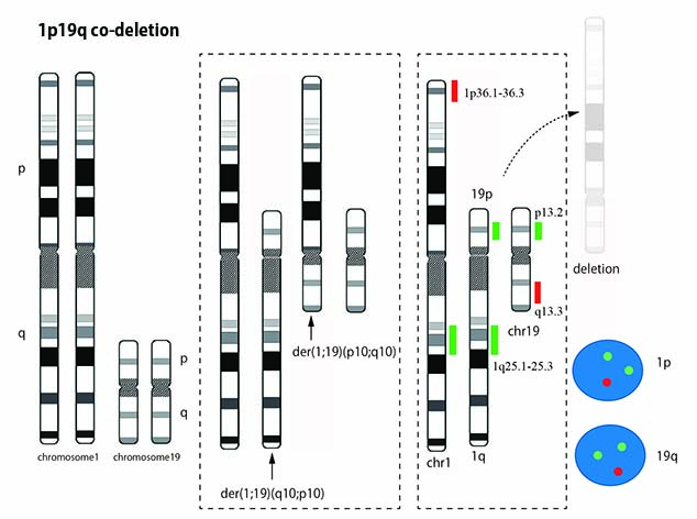 1p19q-codeletion.jpg