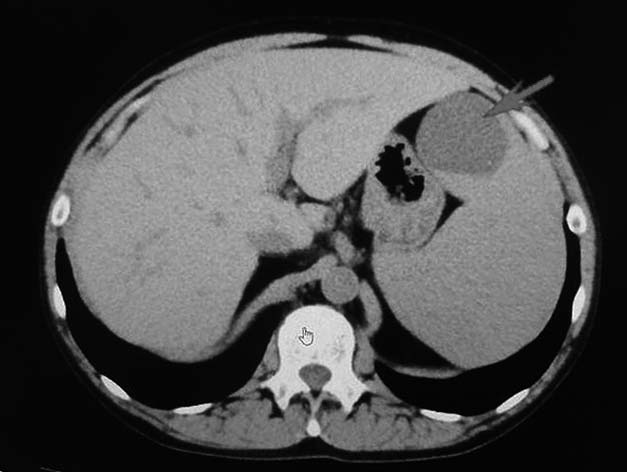 splenomegaly.jpg