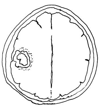 braintumor01.jpg