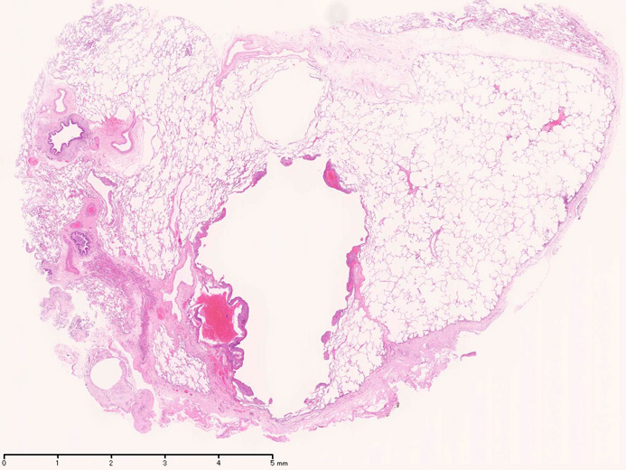 lungcyst01.jpg