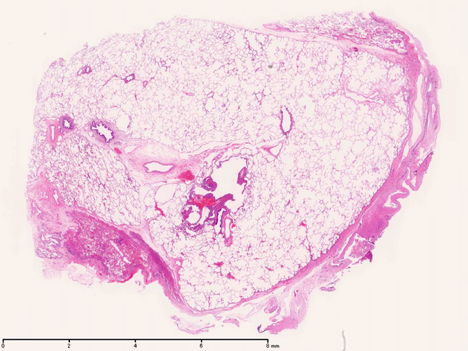 lungcyst02.jpg