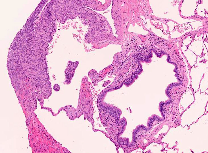 lungcyst04.jpg
