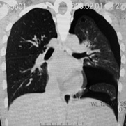 pneumothorax.jpg
