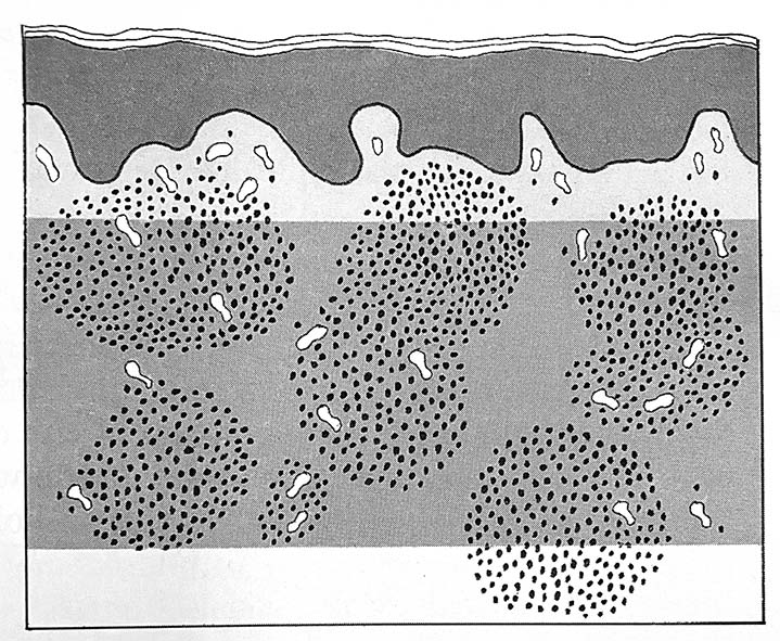 Nodular dermatitis01-ok.jpg