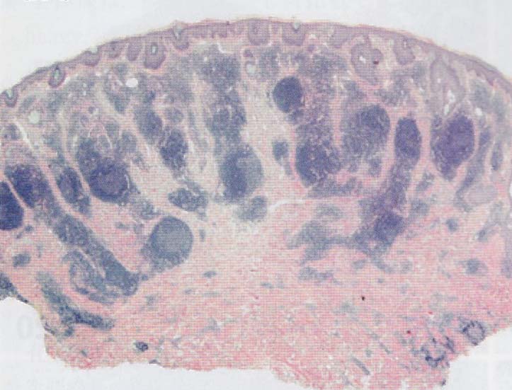 pseudolymphoma-top heavy.jpg