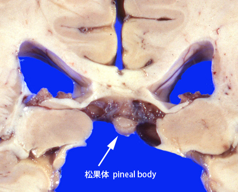 pinealbody.jpg