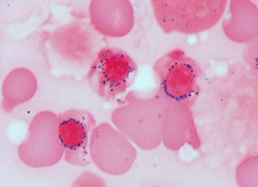 ringed_sideroblasts01.jpg