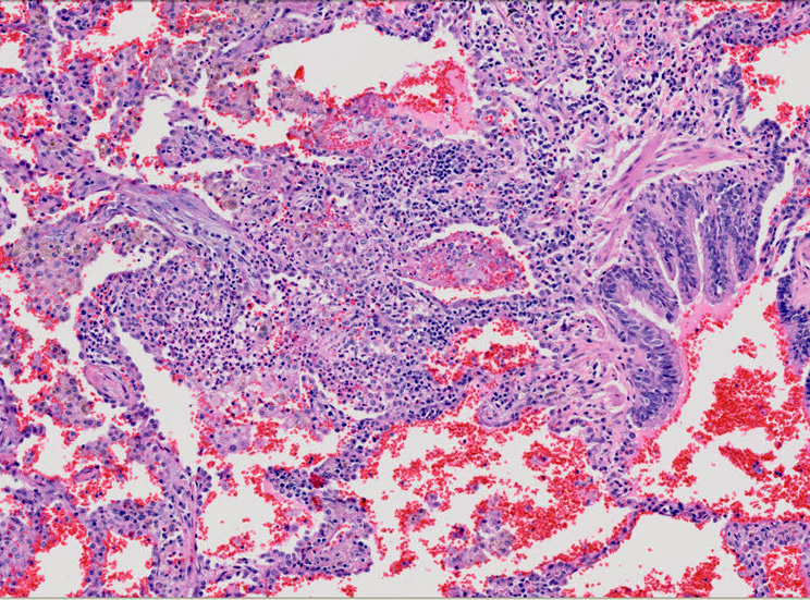 capillaritis01.jpg