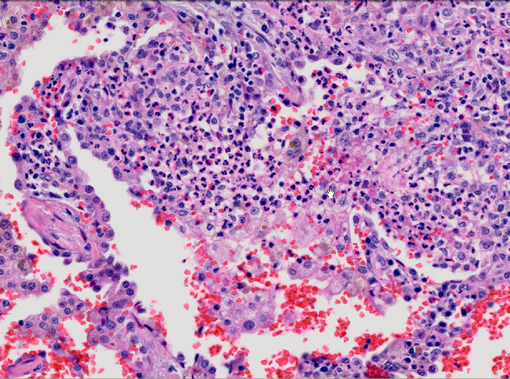 capillaritis02.jpg