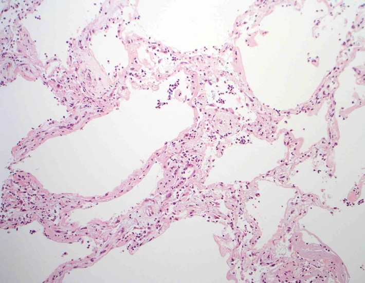 lung01.jpg