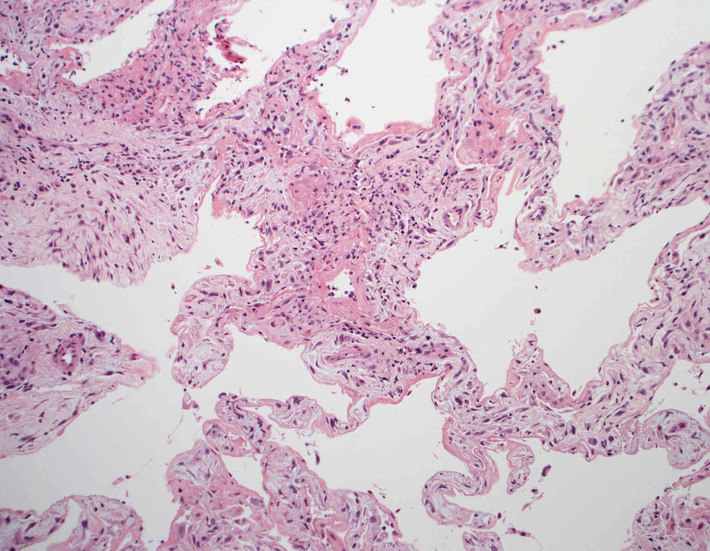 lung03.jpg