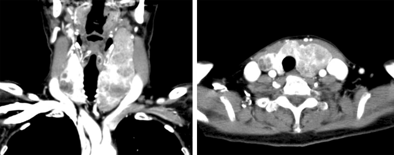 Urk-CT-thyroid.jpg