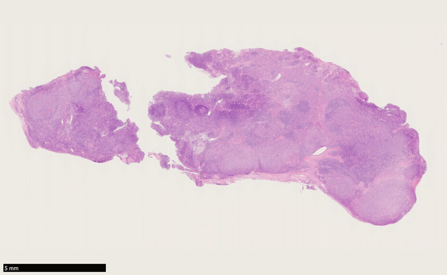 Urk-thyroid-loupe01.jpg