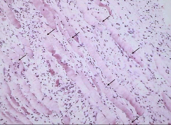 tumorbiopsy.jpg